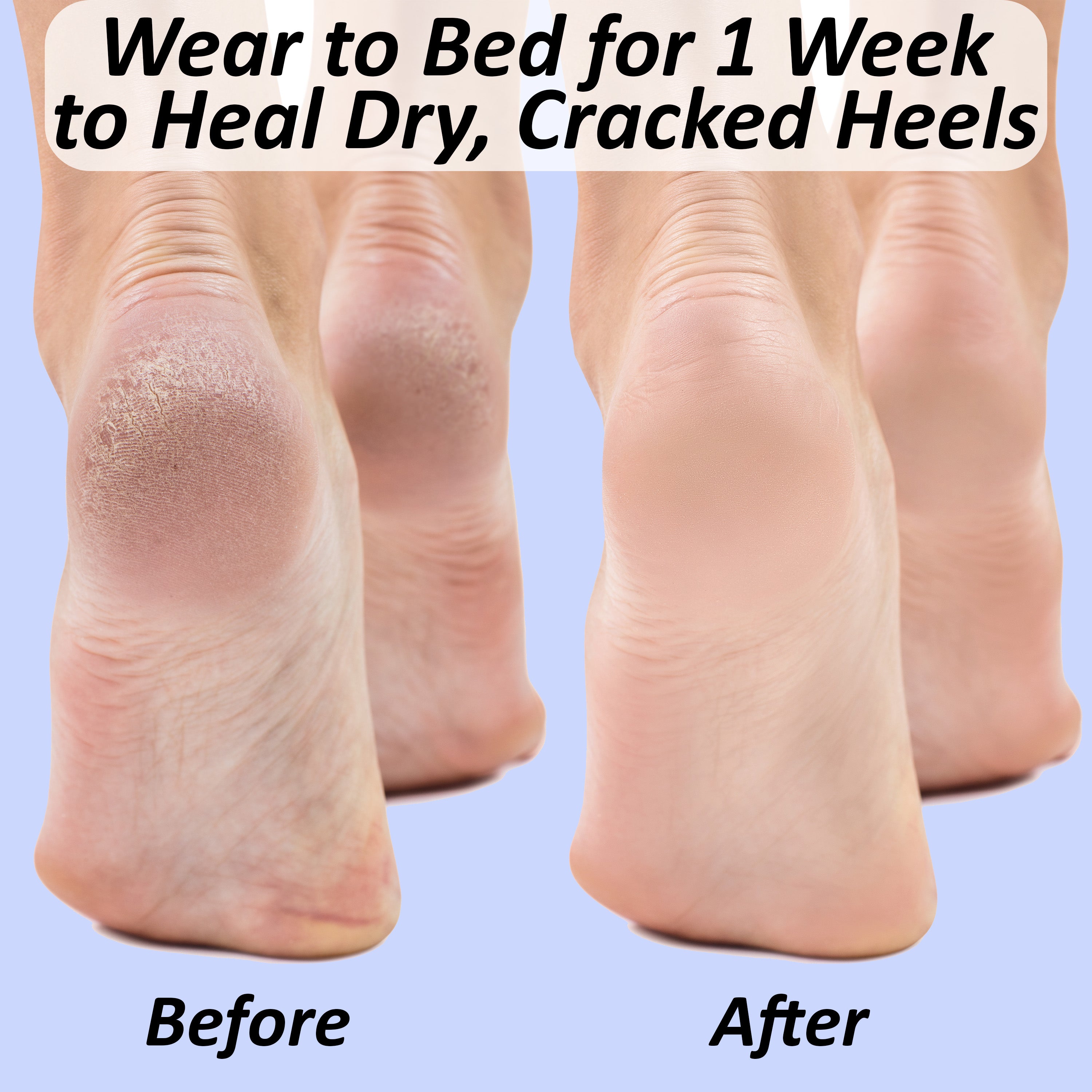 Amazon.com : DCF Gel Moisturizing Heel Socks - Heel Socks for Dry Cracked  Feet, Gel Heel Repair Socks for Cracked Heels, Moisture Socks for Women Dry  Feet, Moisturizing Spa Socks for Overnight -